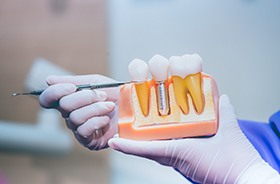 Dentist using model to explain importance of osseointegration