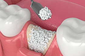 Illustration of bone graft in empty tooth socket