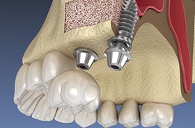 Illustration of implants in jawbone after sinus lift