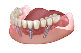 Illustration of All-on-4 treatment for lower dental arch