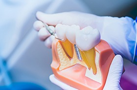 Gloved hands holding model, explaining dental implant treatment