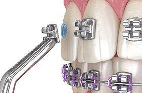 Illustration of braces brackets being attached to teeth