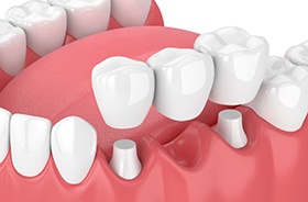 Illustration of three-unit bridge being placed on teeth