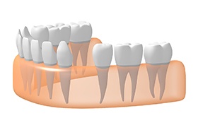 Illustration of dental arch with a missing tooth
