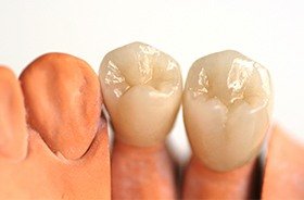 Dental crowns on model smile