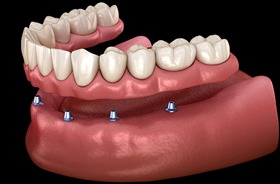 implant-retained dentures