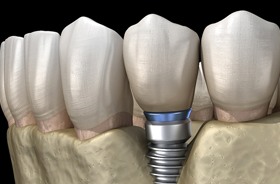 Illustration of bone receding around a dental implant
