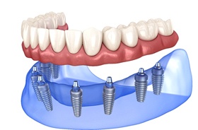 Illustration of dental implant dentures for lower arch
