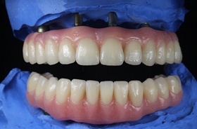 Full set of implant dentures on jaw model