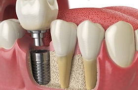 Diagram of single tooth dental implant in Hamden being placed