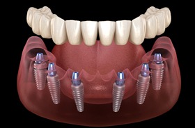 Illustration of dental implant denture for lower arch