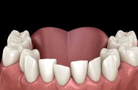 Illustration of crowded, crooked teeth in lower dental arch