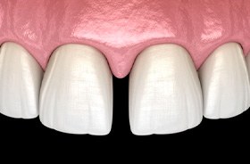 Close-up illustration of gap between front teeth