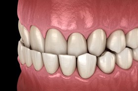 Illustration of an underbite against dark background