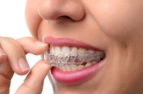 Woman placing Invisalign tray