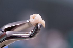 A dental instrument holding an extracted tooth