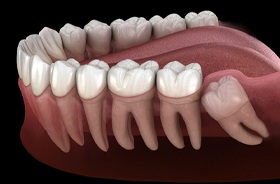 Image of a wisdom tooth below the gum line