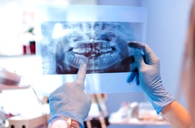 Dentist reviewing X-ray to determine if patient needs filling