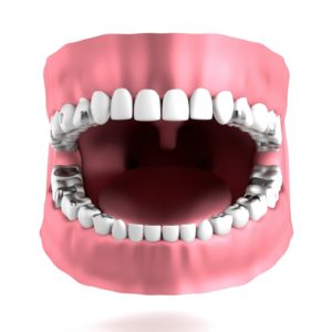 Illustration of mouth of person who should replace metal fillings