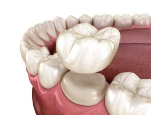 Illustration of dental crown in Hamden being placed on tooth