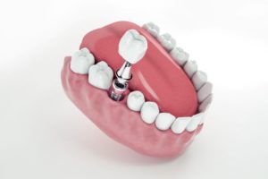 Illustration showing dental implant in lower dental arch