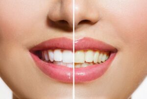 Woman’s smile before and after teeth whitening